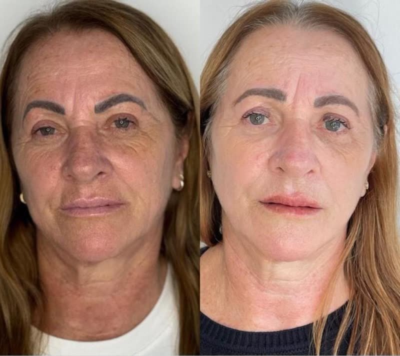 Antes e depois de rejuvenescimento facial