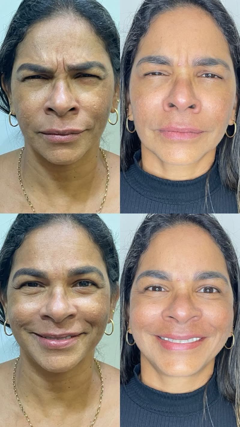 Antes e depois de toxina botulínica na testa e glabela